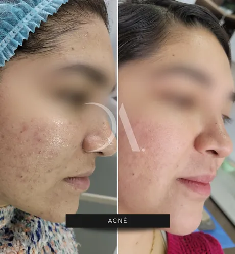 Antes y después de tratamiento para el acné