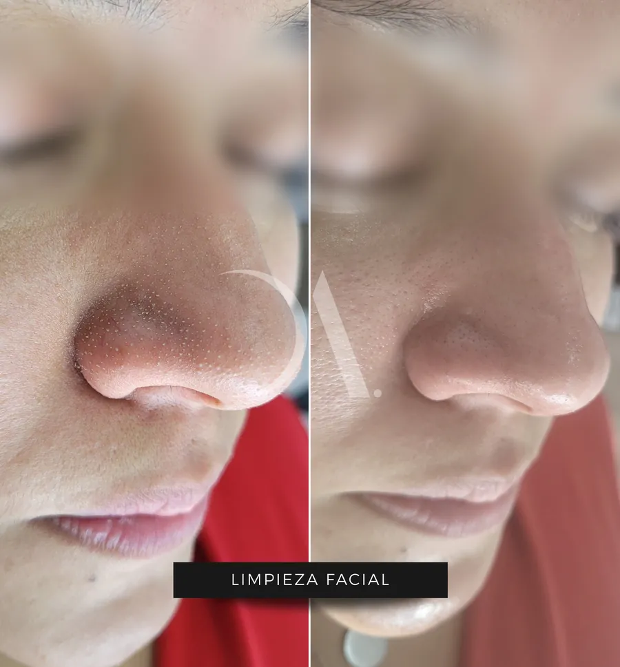 Antes y después de limpieza facial profesional
