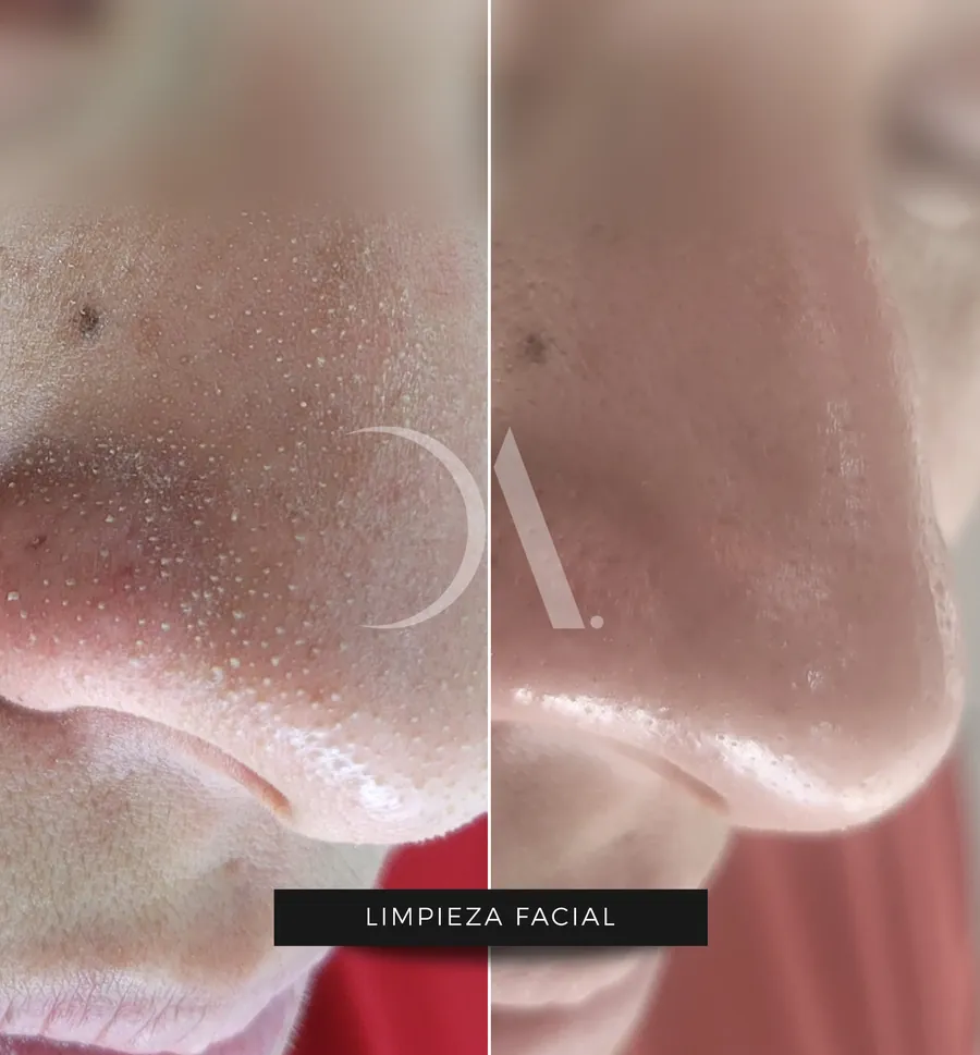 Antes y después de limpieza facial con hidrodermoabrasión