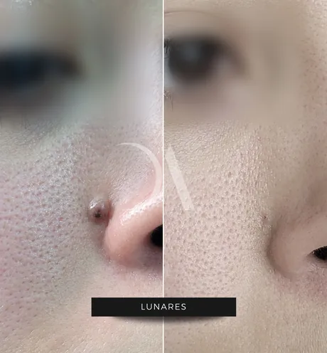 Antes y después de remoción de lunares