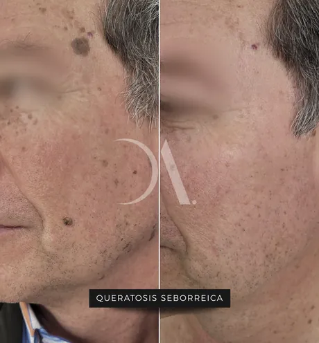 Antes y después de tratamiento de queratosis seborreica
