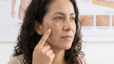 Manchas en la cara: por qué salen y qué se puede hacer