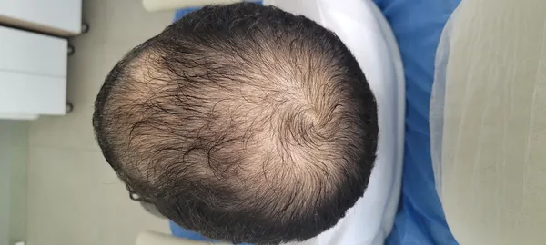 Evaluación de alopecia con tricoscopia