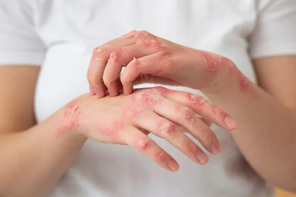Dermatitis en la piel