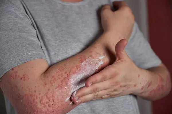 Psoriasis en la piel