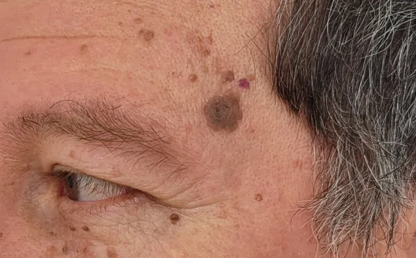 Tratamiento de queratosis seborreicas