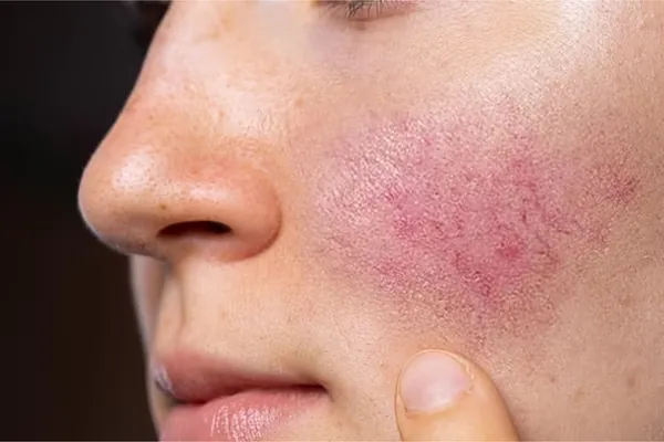 Rosácea facial
